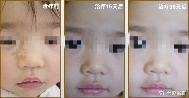 陕西中医药大学第二附属医院:警惕!这种常见的胎记——咖啡斑