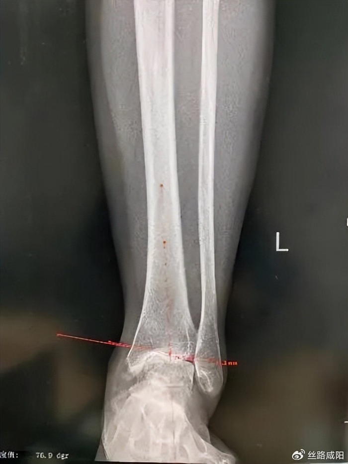 二一五医院:拒绝"因病躺平",足踝外科喜提"护踝使者"美誉!