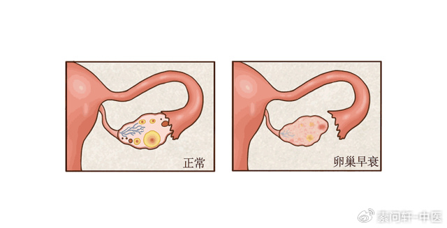 月经|卵巢早衰|膏方_新浪新闻