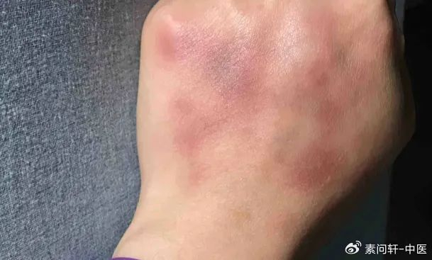每天揪一揪,背部通畅脸干净,补阳气还不上火|手背|后背|缩影|脏腑|尾椎_新浪新闻