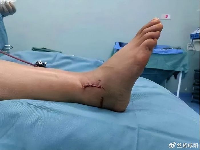外形较术前明显改善一系列的治疗最终保住了赵女士的原装脚踝关节