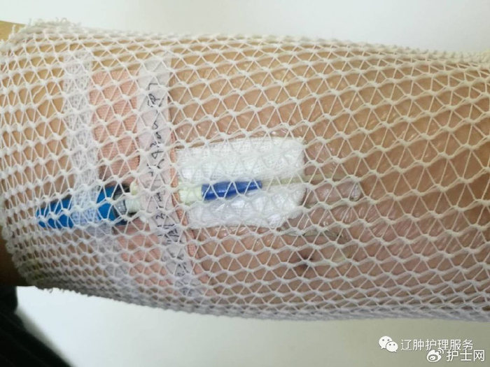 当日换药,如出现潮湿,松动,卷曲,穿刺点渗液,贴膜下导管长度有改变