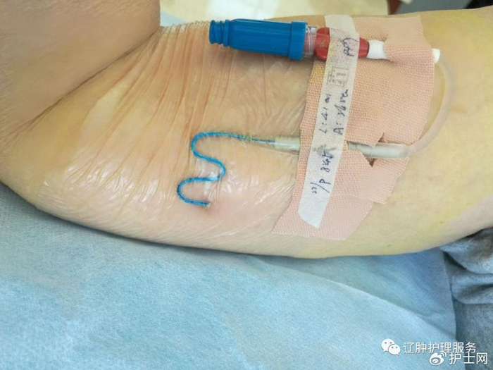 二患者方面(1)按时到正规医院进行picc导管维护,维护时携带维护手册