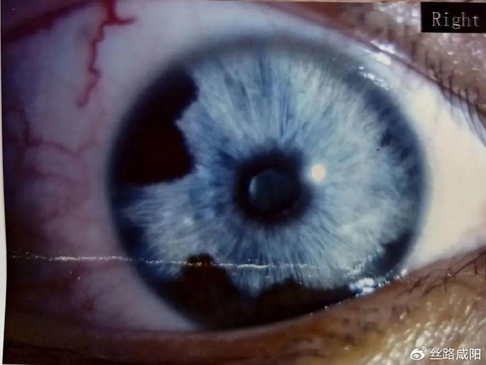 咸阳市一院:3000度近视 罕见葡萄膜炎,眼球像吹爆的气球!