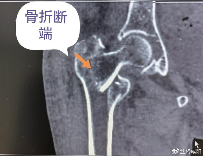 骨折术前ct由于患者为高龄女性,手术风险高,为确保围手术期安全,术前