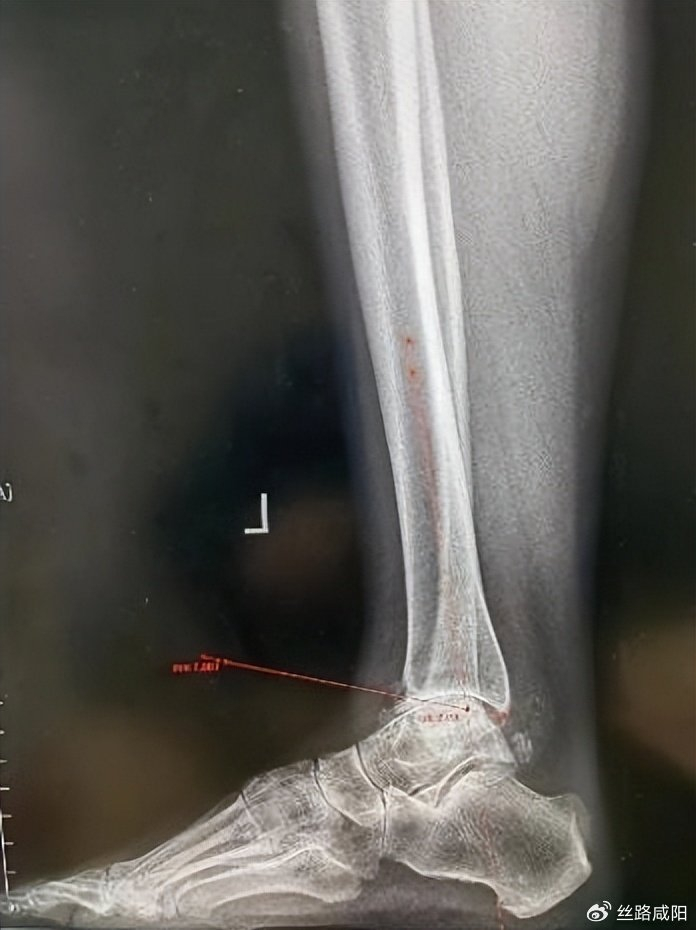 二一五医院:拒绝"因病躺平",足踝外科喜提"护踝使者"美誉!