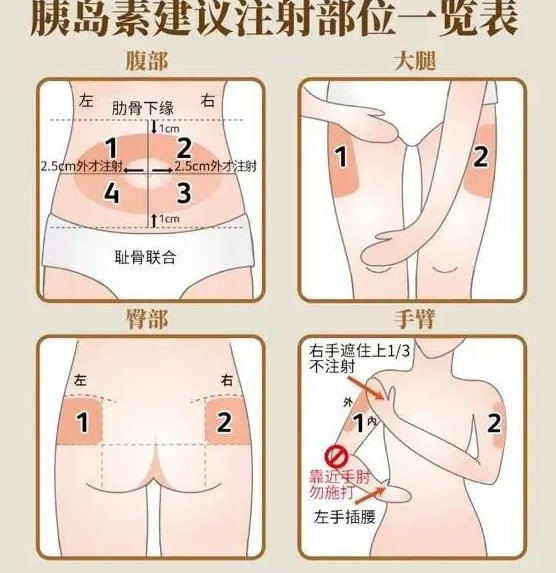 人体适合注射胰岛素的部位都需要皮下脂肪丰富,易于操作,血管神经分布