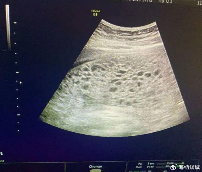 孕17周遭遇罕见双胎之一葡萄胎 沧州妇幼多学科协作护航母婴安全|医疗|葡萄胎|张女士_新浪新闻