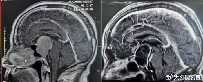 医生应用电生理监测辅助精准"摘"瘤|垂体瘤|南华|手术_新浪新闻