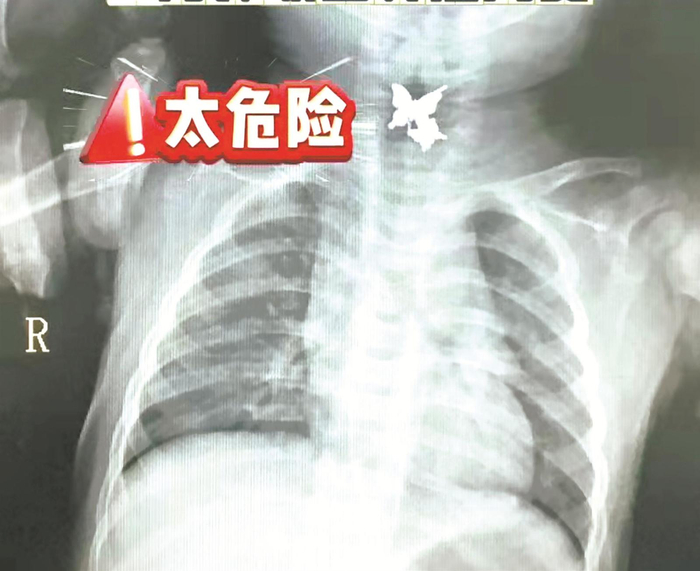 9月龄女婴误吞耳钉医院5分钟化险为夷