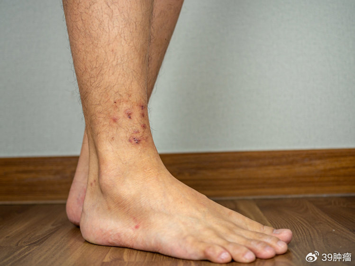 糖尿病人出现6种情况,必须马上住院,否则生命可能有危险