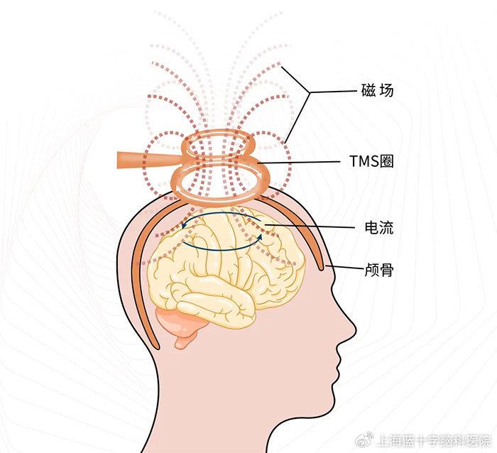 经颅磁m1区体表定位图片