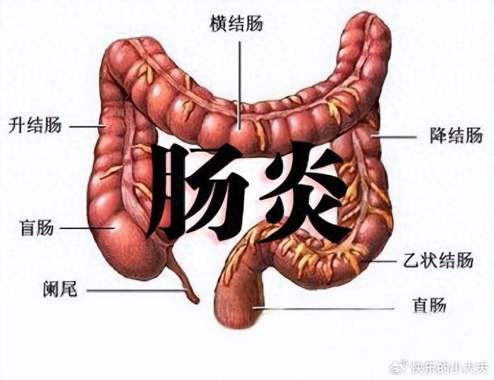 结肠炎怎么治疗图片