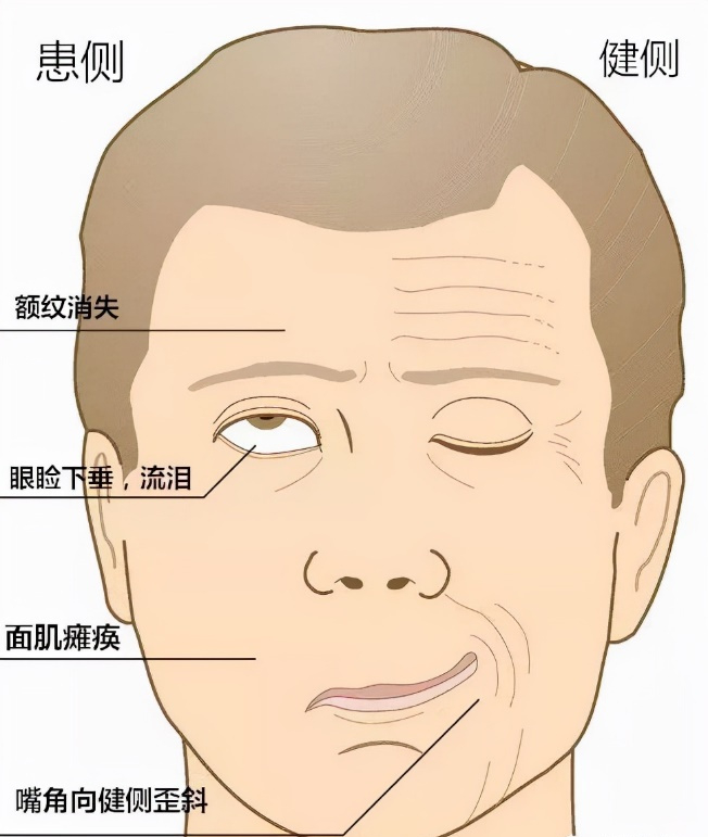 面瘫,也就是面神经炎,俗称"歪嘴巴""吊线风",是以面部表情肌群运动