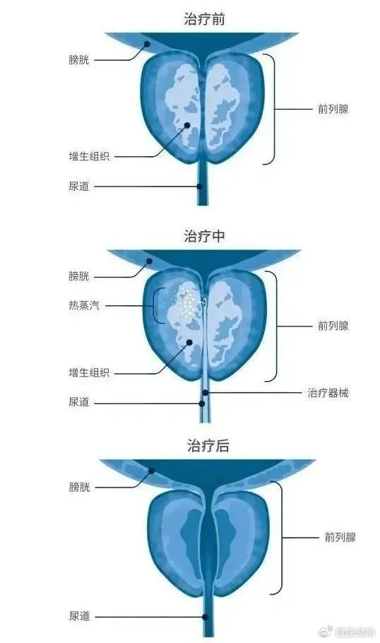 湖南中医附一:超微创!5分钟解决92岁老人前列腺增生|良性前列腺增生|前列腺疾病|泌尿外科|手术|外科_新浪新闻