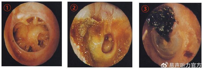 【震惊】中耳炎不仅影响听力,甚至可能危及生命