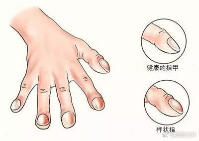 鼓槌状的手指,是病态的反应!|杵状指|鼓槌|手指_新浪新闻