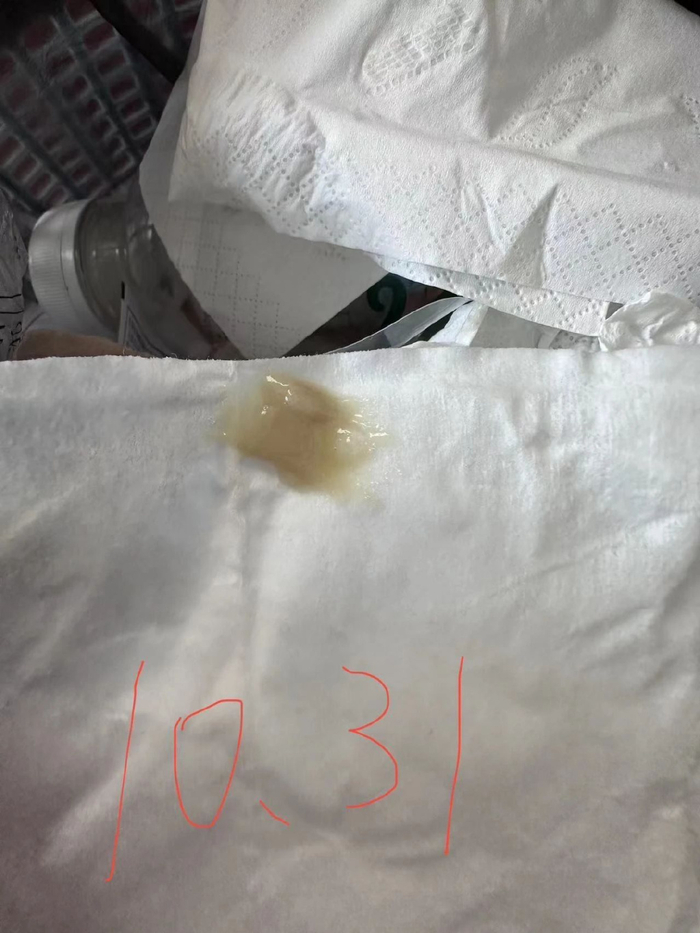 大家见下图,这是我让门诊患者记录的,随着痰出来,孩子的咳嗽越来越轻