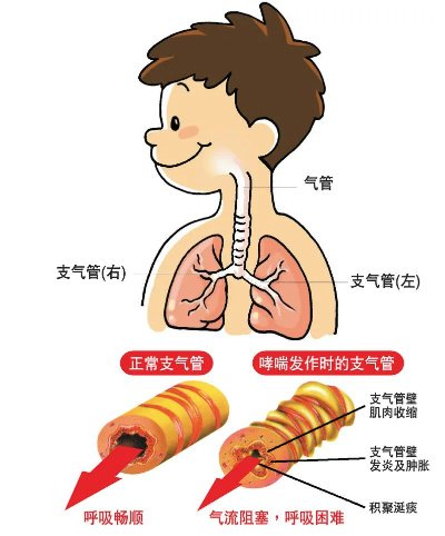 哮喘|气管|患者_新浪新闻
