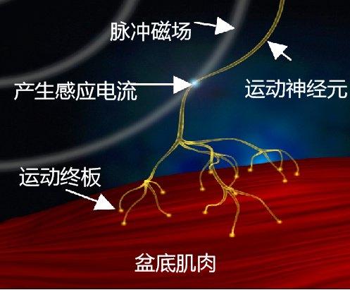 盆底磁疗的作用及危害=盆底磁疗治疗仪的作用与效果
