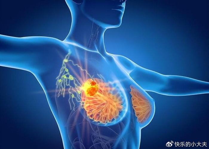 关于乳腺癌5个问题,你都知道吗?全方位了解乳腺癌