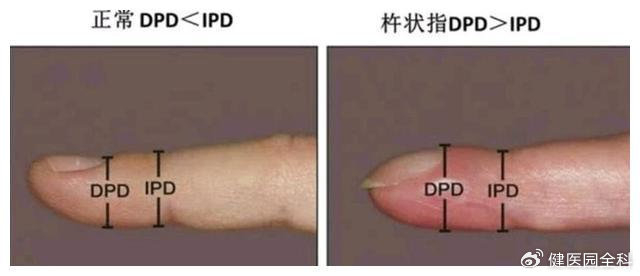 手指头变粗,你可能患有这些疾病!