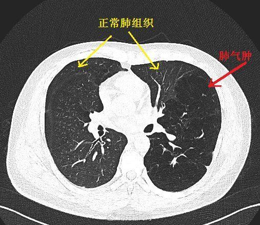 肺气肿胸片图解图片