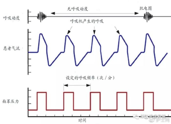 呼吸曲线图及分析图片