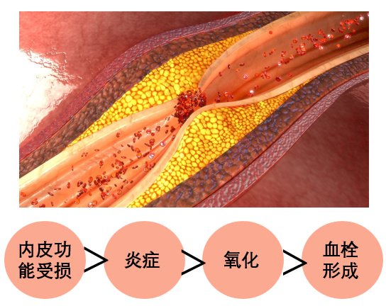 有血管斑块的患者，养生切记持之以恒！|林伯伯|伯伯|炸弹|因子|动脉粥样硬化_新浪新闻