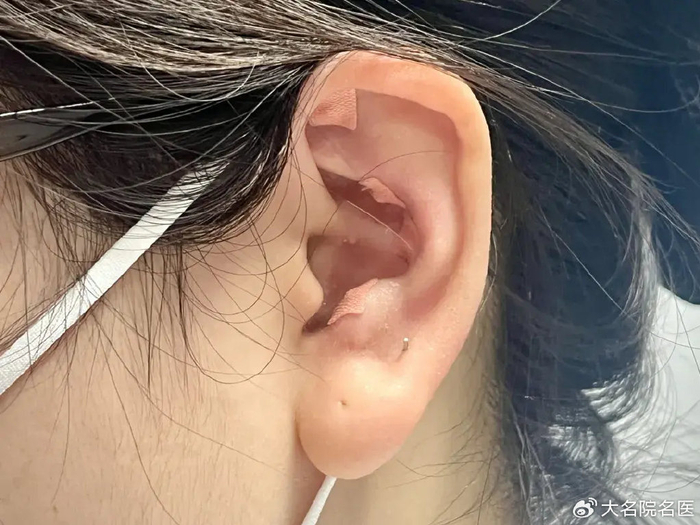 降压耳穴的选择上,遵循辨证论治的原则,可以有多种选择,如耳穴肝区可