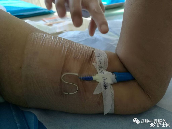picc:0°揭敷料,Ω固定法,好经验快收藏!|导管|贴膜|敷料_新浪新闻