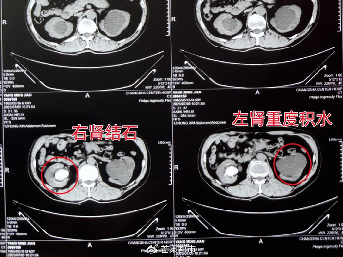 杨先生术前ct局部检查图男子一天仅喝一瓶水,体检意外发现双肾结石"我