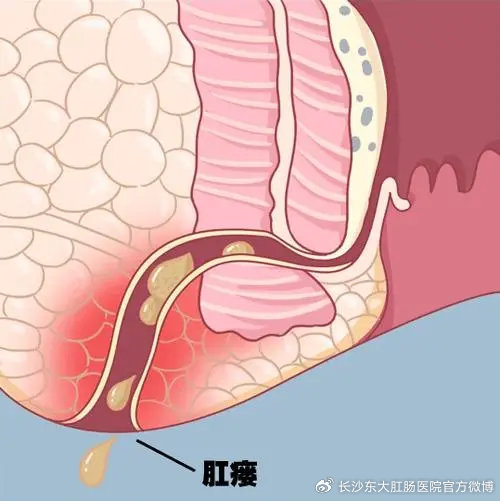 长沙东大肛肠医院:肛瘘究竟会不会自愈?