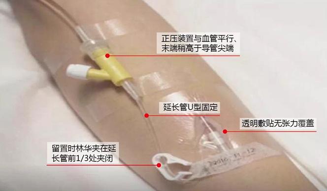 留置针堵管图片图片