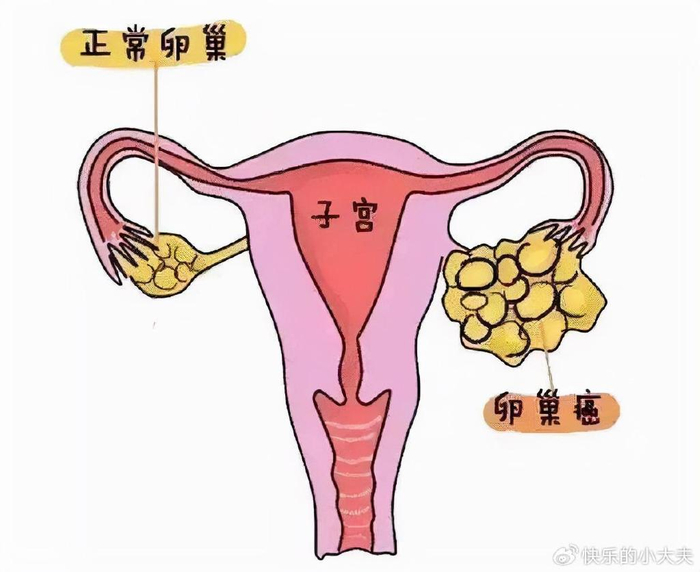 卵巢癌是卵巢肿瘤的一种恶性肿瘤,卵巢癌源于卵巢上皮细胞或生殖细胞