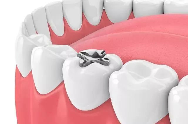 植得口腔医生讲解补牙新选择|陶瓷|嵌体|牙齿_新浪新闻