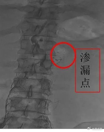 咸阳市中心医院新技术 1:乳糜漏怎么破?