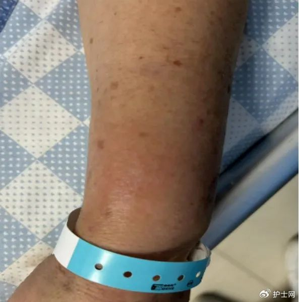 输液后手背又红又肿,是何原因?如何处理?|输液|护士_新浪新闻