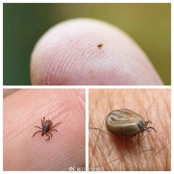 蜱叮咬-动物所致皮肤病