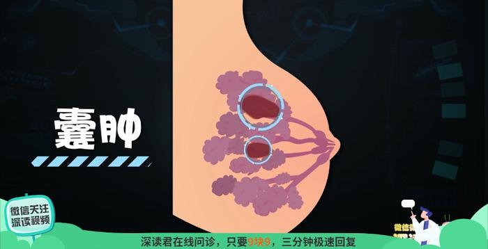 你的乳腺增生了吗?你知道你离乳腺癌只有两步吗?