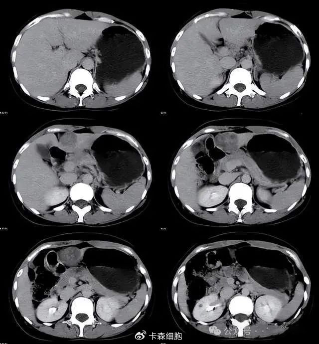 晚期弥漫性肝癌,经治疗后肿瘤缩小,生活质量显著提高