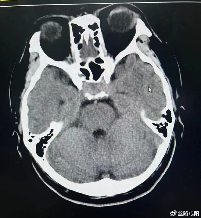 垂体瘤|肺癌|垂体_新浪新闻