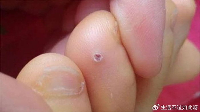 脚上长鸡眼太疼了,用一根香烟就能解决,省钱省事,真是涨知识了