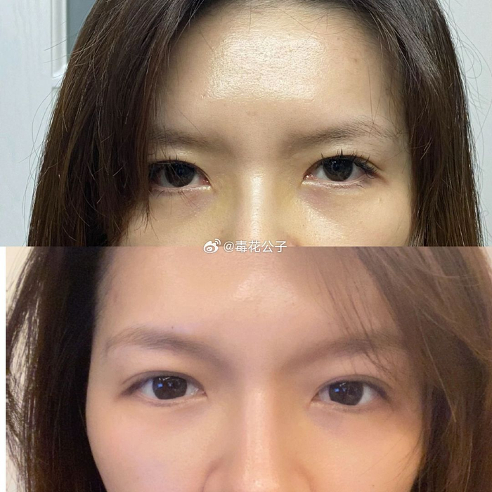 找了一下眉心三角77泪沟填完前后的对比