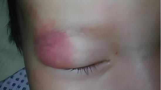 当宝宝出生，发现宝宝身上有胎记以后