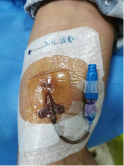 预防picc穿刺点感染 这些重点环节必须关注