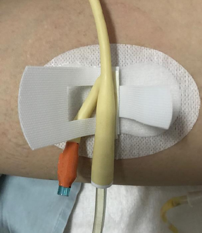 导管贴"窗口处"穿出,魔术贴交叉粘贴,起到有效的二次固定,尿管不会
