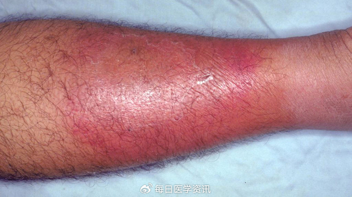 22.蜂窝组织炎