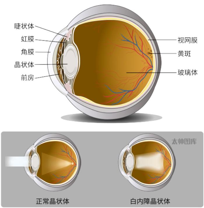 18张常见白内障图解图片