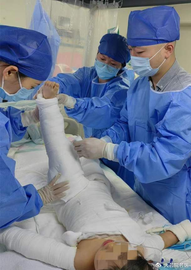 3岁女童坐进开水盆全身大面积烫伤,专家联手护她连闯生命关卡!